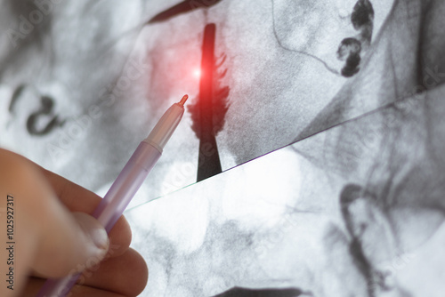 Doctor examining X-ray image of Hysterosalpingography (HSG). MRI with contrast agent. Uterine tubes, analysing female reproductive system. Infertility treatment. photo