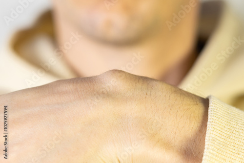 Hygroma of the man's wrist. Ganglion cyst on hand. Close up. photo