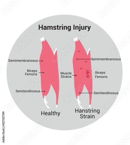 Hamstring Injury Science Design Vector Illustration Diagram