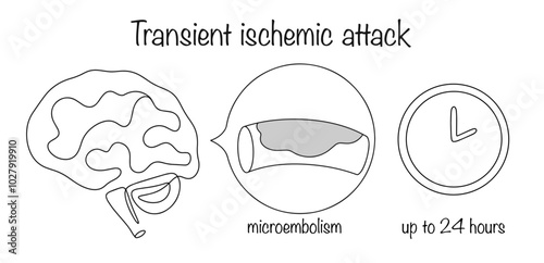 Transient ischemic attack