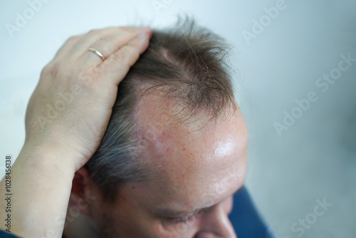 Baldness on the head of a middle-aged man. Hair loss. Alopecia