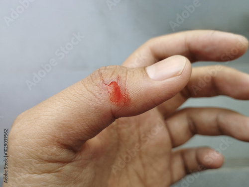 Close-up hand injuries, accidental cuts with knives, real bloody hands.