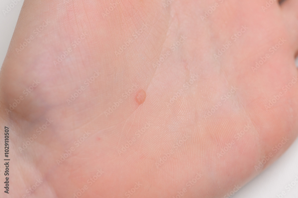 Common flat wart on hand, close-up. Verruca vulgaris on baby skin. Human papillomavirus, HPV. Concept of pediatric dermatology, getting rid of warts Common flat wart on hand, close-up. Verruca vulgaris on baby skin. Human papillomavirus, HPV. Concept of pediatric dermatology, getting rid of warts
