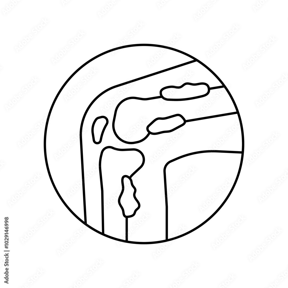 bone cancer disease