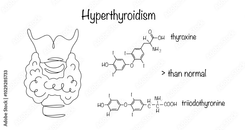 Obraz premium Hyperthyroidism