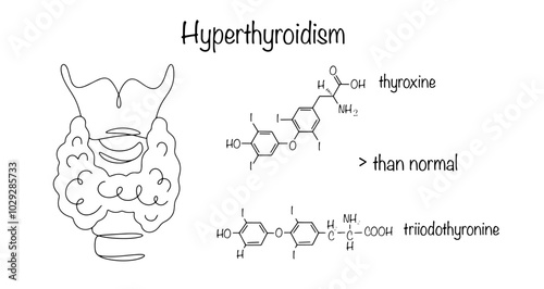 Hyperthyroidism