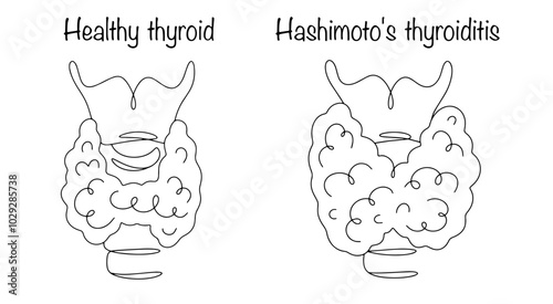 Hashimoto's thyroiditis