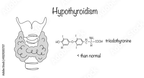 Hypothyroidism