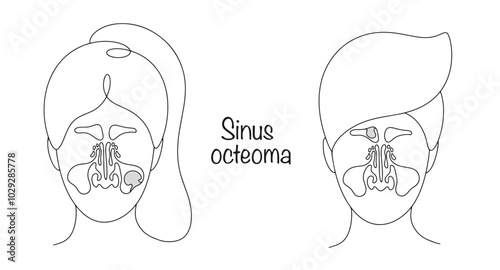 Sinus osteoma