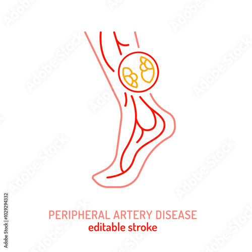 Peripheral artery disease outline icon. PAD linear pictogram.