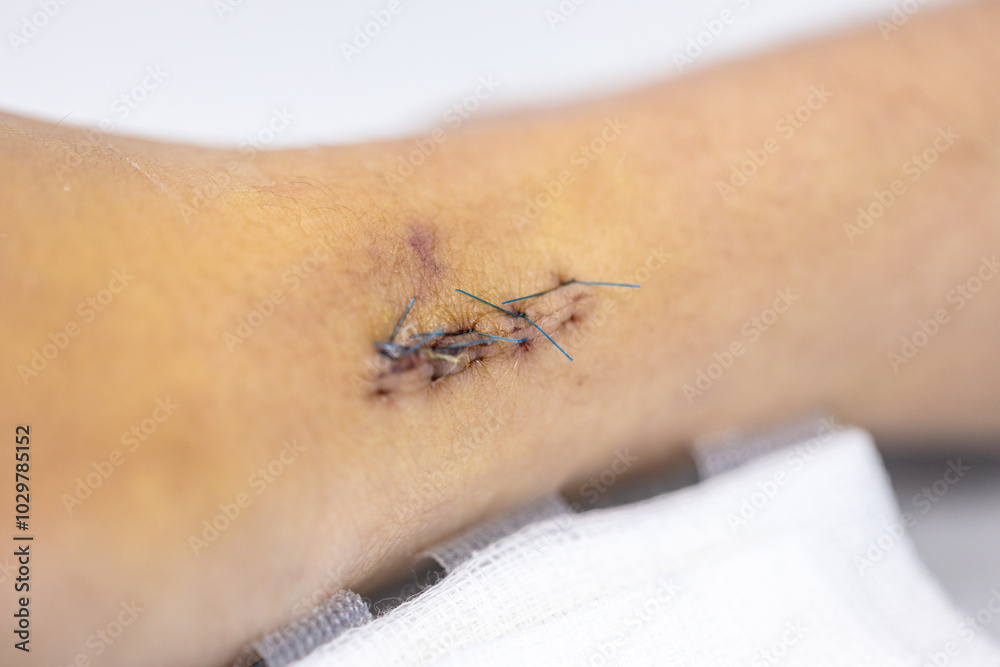 Obraz premium Wound and Scar on different parts of the body, Caused by an accident. 