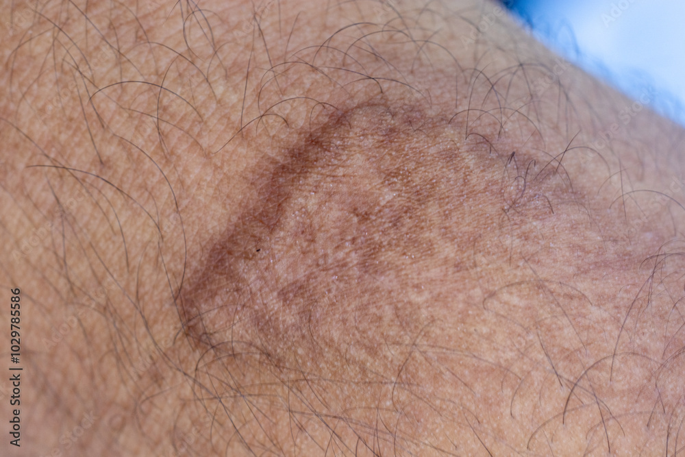 Wound and Scar on different parts of the body, Caused by an accident.	