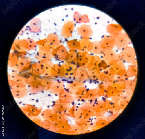 Light micrograph of a vaginal smear showing adenocarcinoma cells (center). Vaginal cancer. Inflammatory smear with HPV related changes. Cervical cancer. SCC. photo