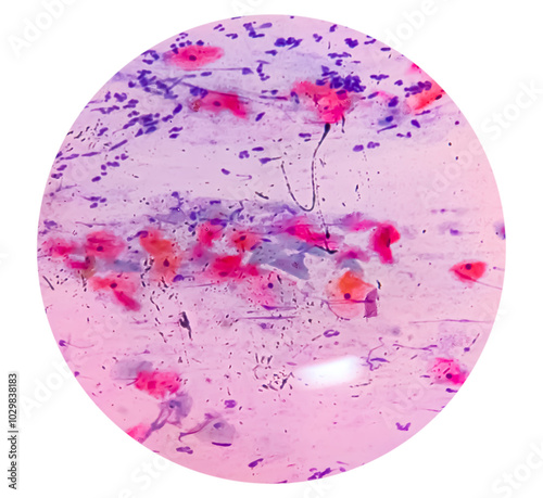 Photomicrograph of urine microscopy, urine cytology, Pap stain. Shows epithelial cells, neutrophils and occasional histiocytes photo