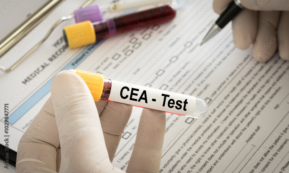 CEA Test concept. doctor holding blood sample tube to Carcinoembryonic ...