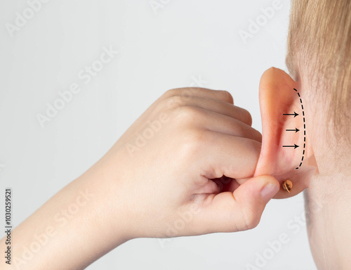 The girl holds her hand on her protruding protruding ear with marks for plastic surgery. Changes in the shape of the pinna and ear. Pediatric otoplasty. Copy space for text photo