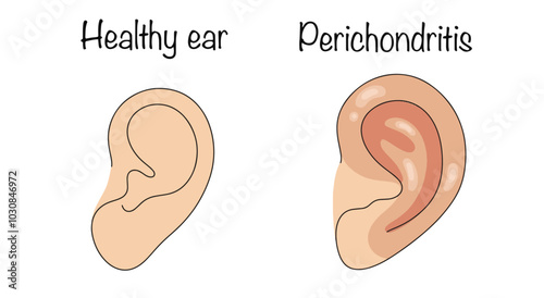 Perichondritis