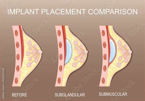 Breast implant placement. Cosmetic plastic surgery. Mammoplasty