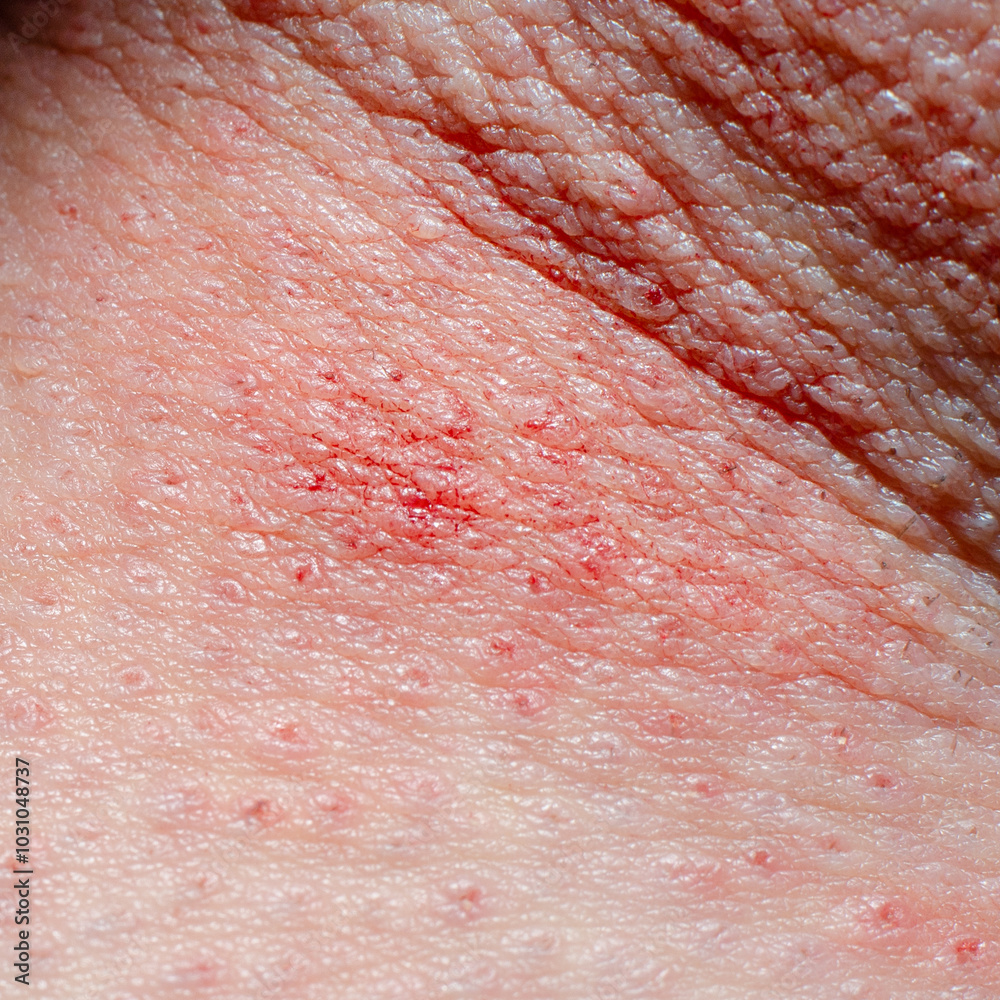 Human body wound. Skin irritation after shaving, pimples and acne and fungus. Human body wound. Skin irritation after shaving, pimples and acne and fungus.