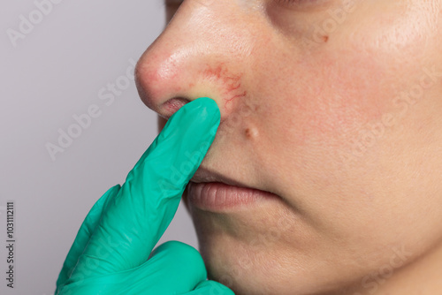 Close up doctor in green gloves examining the inflamed blood vessels on the nose of a young woman suffering from rosacea. Dermatological problems.