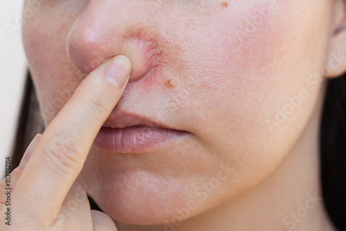 Close-up face of young Caucasian woman showing redness and inflamed blood vessels on her nose. Dermatological problems.  