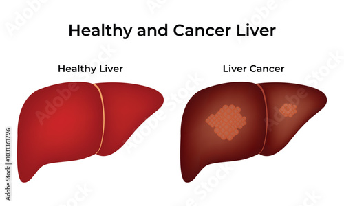 Healthy and Cancer Liver Science Design Vector Illustration Diagram