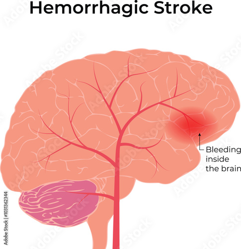 Hemorrhagic Stroke Science Design Vector Illustration Diagram
