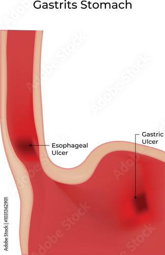 Gastritis Stomach Science Design Vector Illustration Diagram