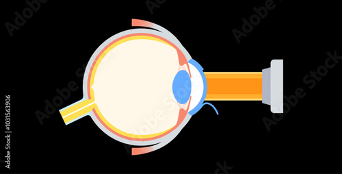 Lasik eye surgery