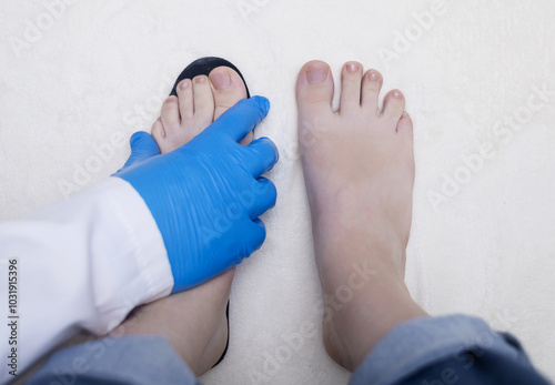 Presentation of incorrect footwear that deforms the foot. Small size of the insole, which causes pain in the foot and valgus. After an example of an anatomical insole photo