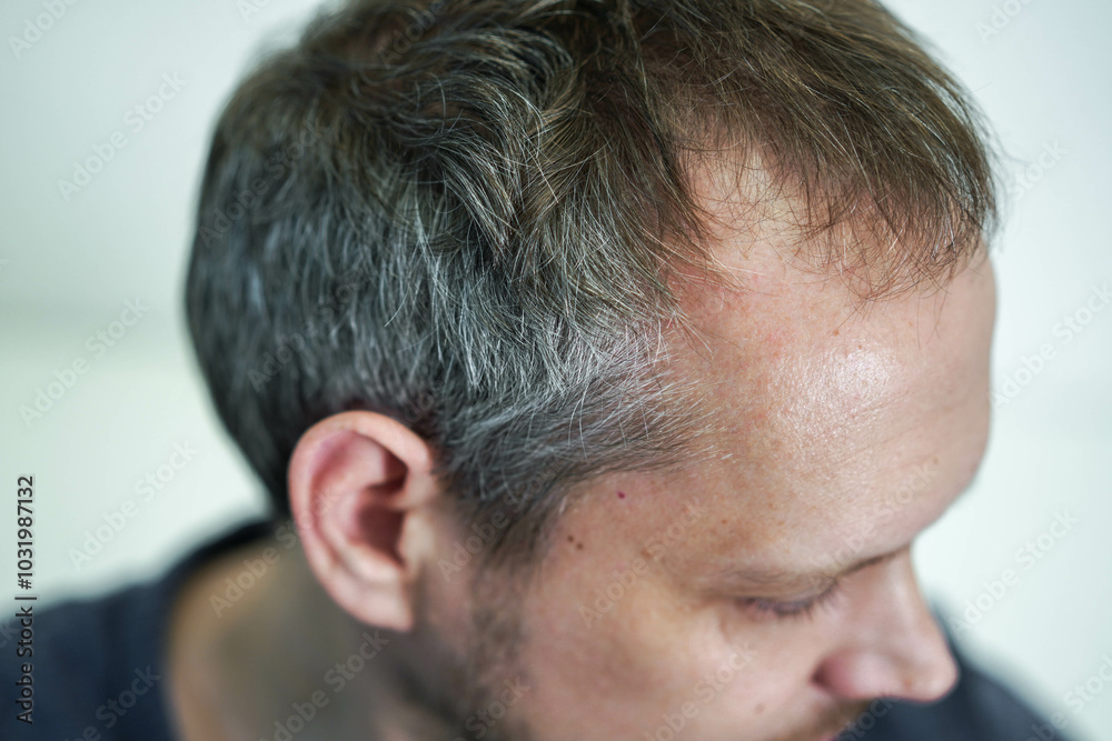 Baldness on the head of a middle-aged man. Hair loss. Baldness on the head of a middle-aged man. Hair loss.