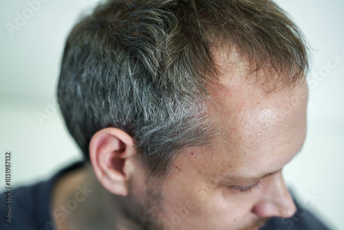 Baldness on the head of a middle-aged man. Hair loss.