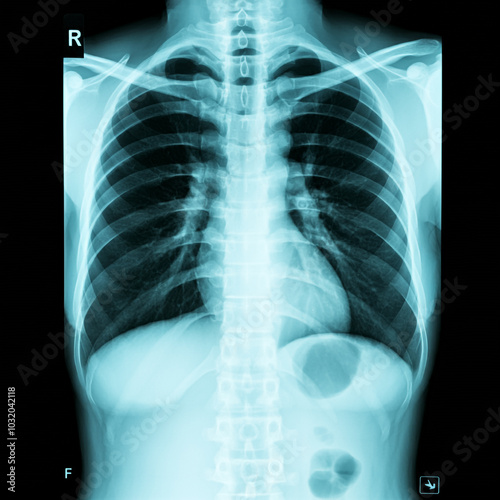 X-ray image of a human ches...