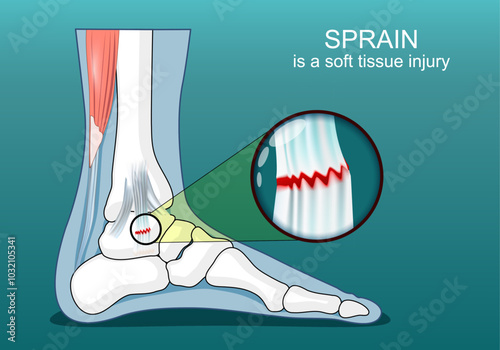 Ankle ligament sprain