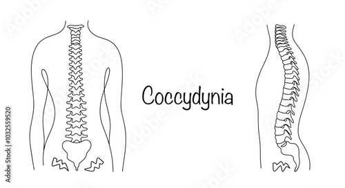 Coccydynia