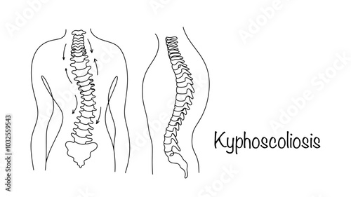 Kyphoscoliosis