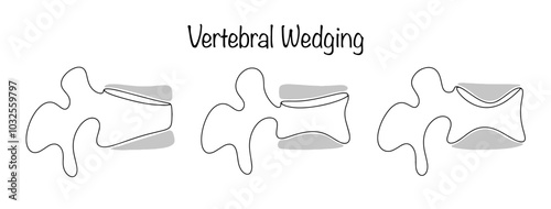 Vertebral Wedging