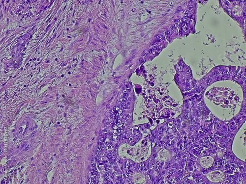 Background of human ovarian cyst cell tissue under microscope in pathology laboratory. View microscopically positive cervix, adenocarcinoma, tissue sections by H and E photo