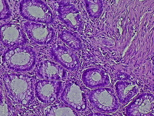 Photomicrograph of rectal cancer. Squamous cell carcinoma of the rectum. adenocarcinoma, microscopic view. photo