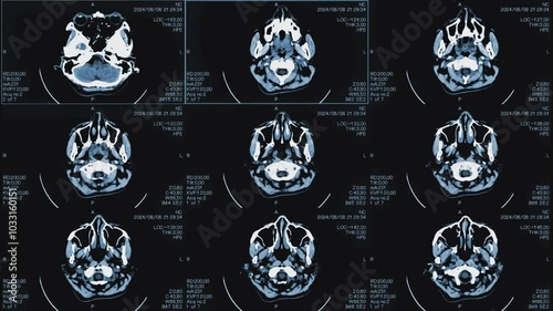 Magnetic resonance images of the brain, MRI of the brain, of a patient with multiple vascular infarctions, front view, monochrome animation Seamless Loop. 