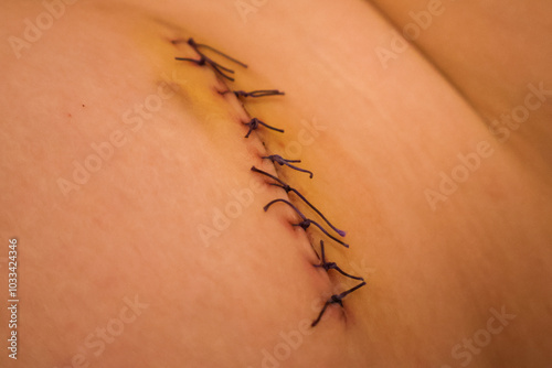 Close-Up of Surgical Stitches on Healing Skin photo