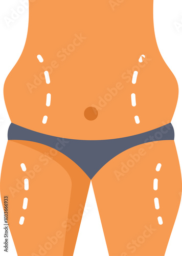 Woman's body undergoing a body contouring procedure with markings showing the areas of liposuction