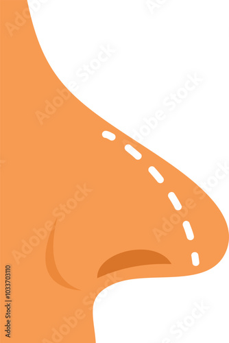 This illustration shows a rhinoplasty procedure being performed on a nose