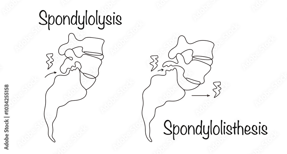 Obraz premium Spondylolysis. Spondylolisthesis