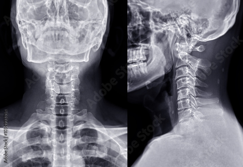 X-ray images of the cervical spine in AP and lateral views, showing normal vertebral alignment and no signs of abnormalities.