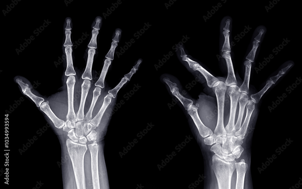 X-ray image of a normal hand, showing well-aligned bones and joints with no visible abnormalities. X-ray image of a normal hand, showing well-aligned bones and joints with no visible abnormalities.