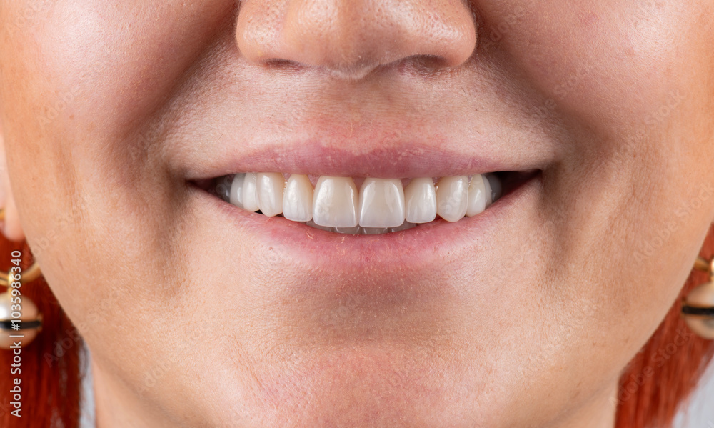 Obraz premium dental crowns and veneers