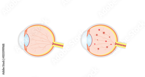 Diabetic retinopathy. Healthy eye and damaged eye. Retinal damage, vision loss. Diabetes disease. Hemorrhages, aneurysms, abnormal blood vessels. Scientific vector illustration.