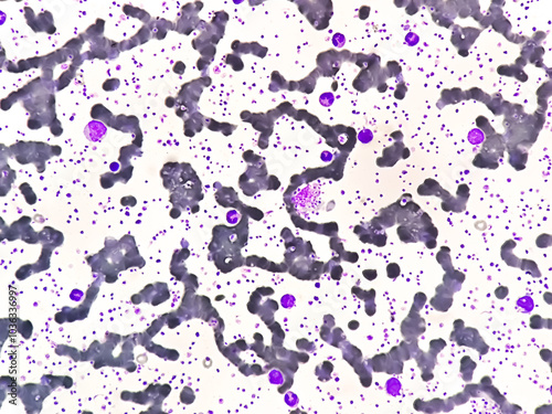 Thrombocytosis blood smear, present abnormal high platelet count analyze by microscope photo