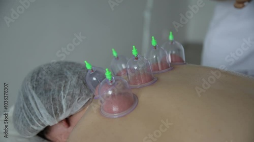 A young doctor practices acupuncture therapy and vacuum cupping in the clinik. photo